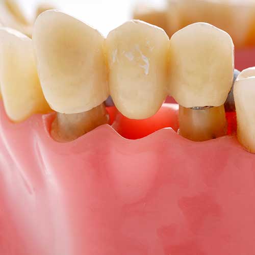 Dental Bridges | Ultima Dental Wellness | SW Calgary Dentist in Kingsland