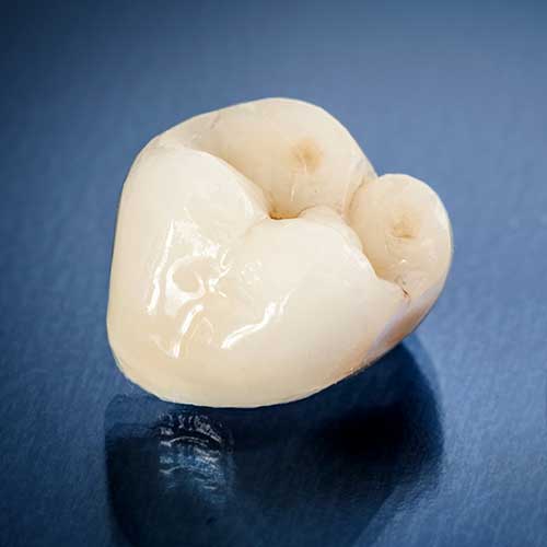 Dental Crowns | Ultima Dental Wellness | SW Calgary Dentist in Kingsland