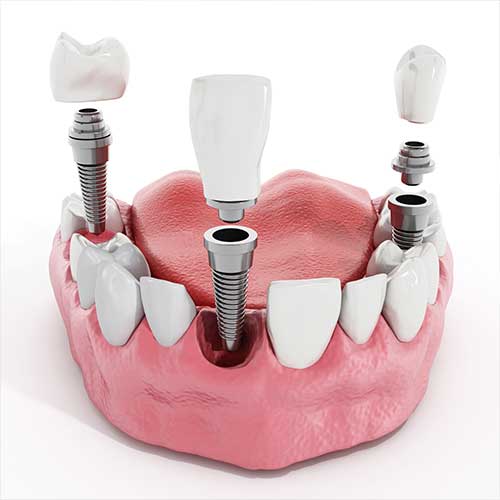 Dental Implants | Ultima Dental Wellness | SW Calgary Dentist in Kingsland