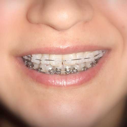 Insignia Braces | Ultima Dental Wellness | SW Calgary Dentist in Kingsland