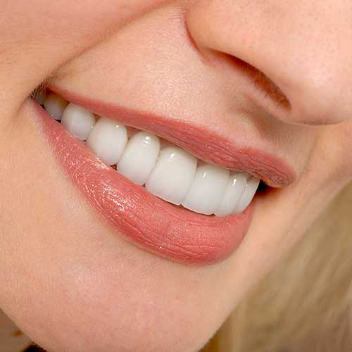 Porcelain Veneers | Ultima Dental Wellness | SW Calgary Dentist in Kingsland