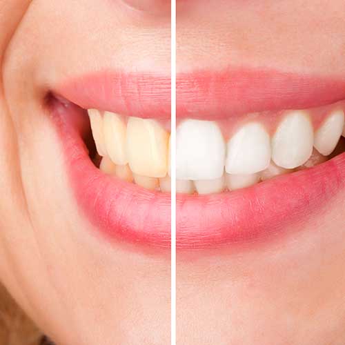 Teeth Whitening | Ultima Dental Wellness | SW Calgary Dentist in Kingsland