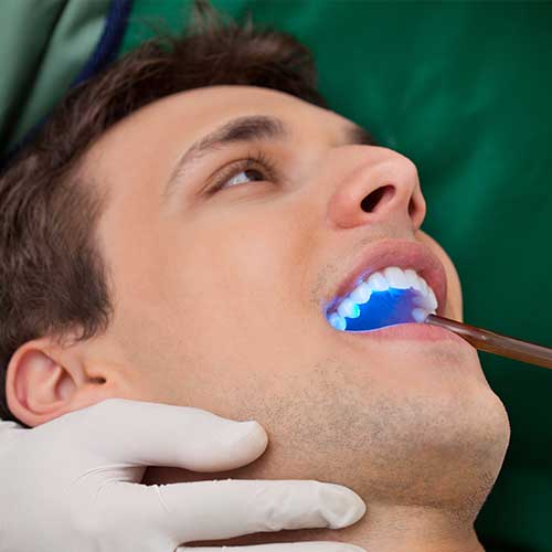 Tooth Bonding | Ultima Dental Wellness | SW Calgary Dentist in Kingsland