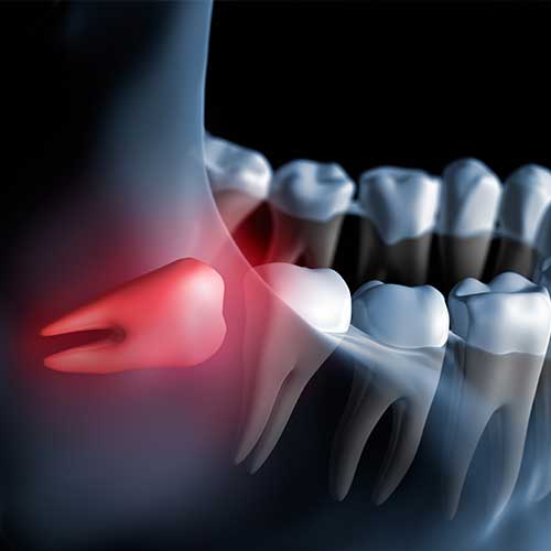 Wisdom Teeth Extraction | Ultima Dental Wellness | SW Calgary Dentist in Kingsland