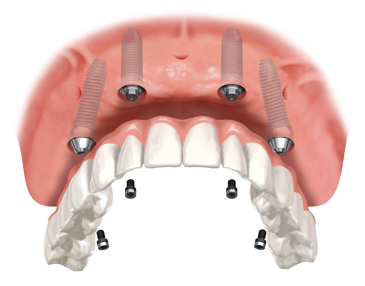 All-On-Four Dental Implants | Ultima Dental Wellness