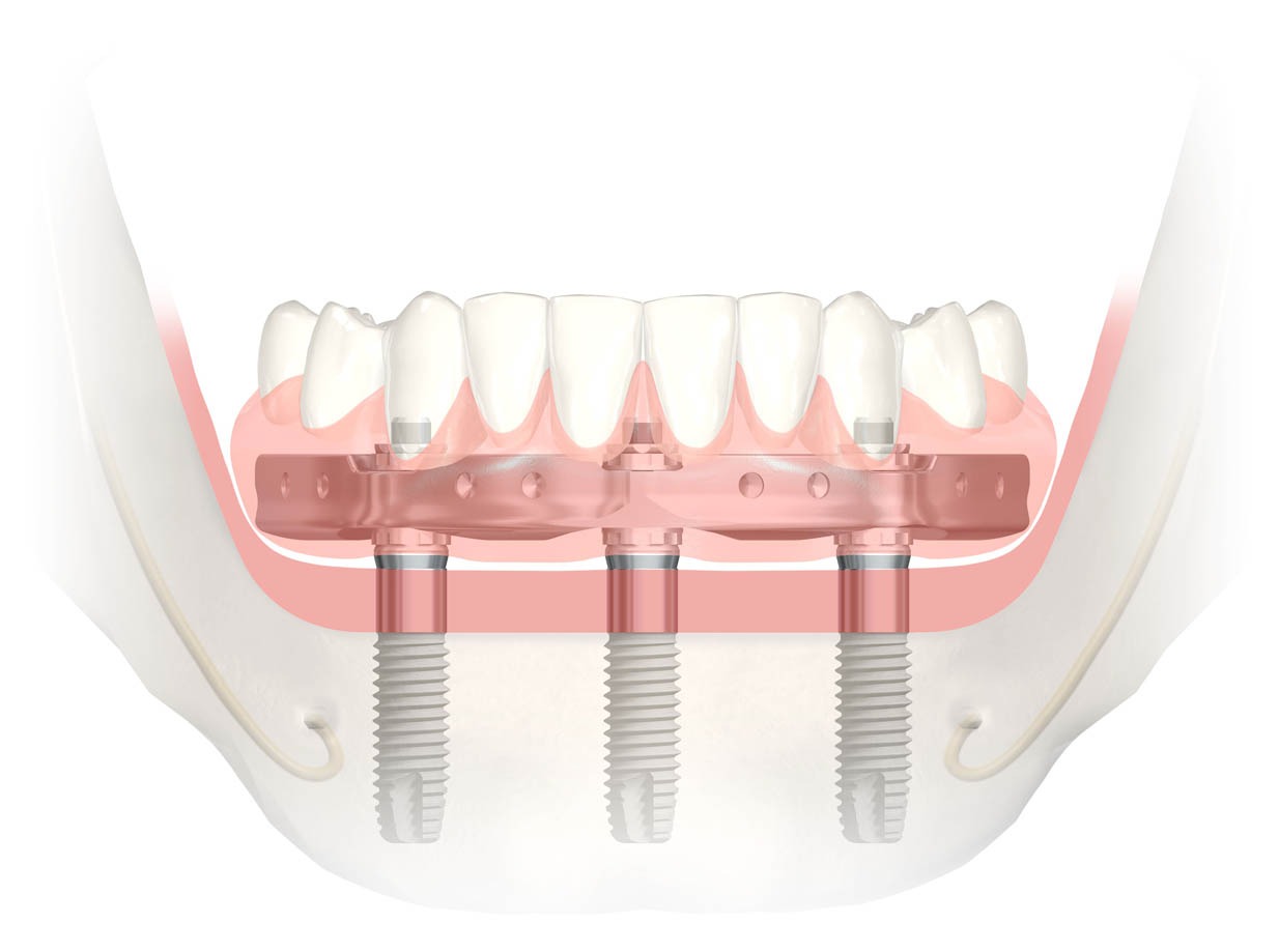 Full Arch Denture Implant | Ultima Dental Wellness