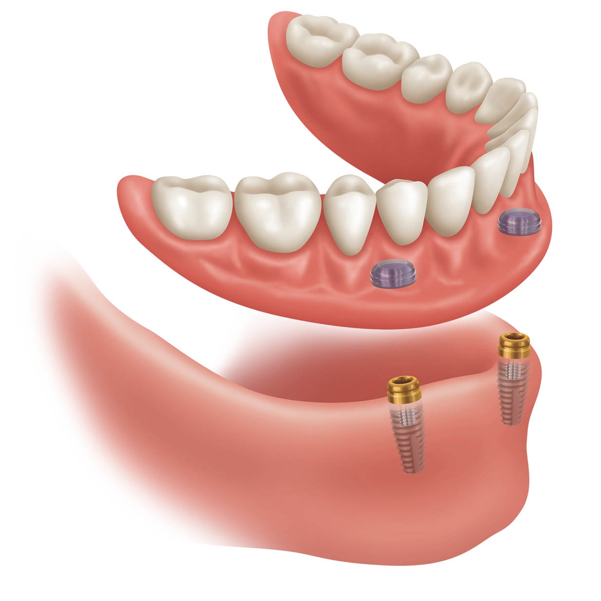 Implant Supported Denturs | Ultima Dental Wellness